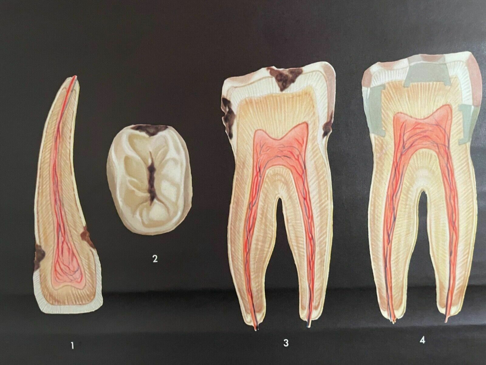 photo vintage Vintage School Chart Teeth In Health & Disease Anatomy Educational Tooth Dental