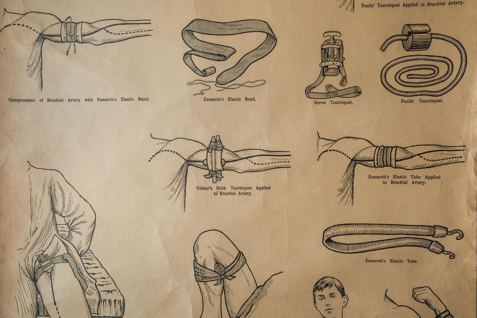 Original Anatomical Vintage British School Wall Chart Haemorrhage Wounds First Aid Anatomy Wright & Sons Tourniquet Compression photo for sale