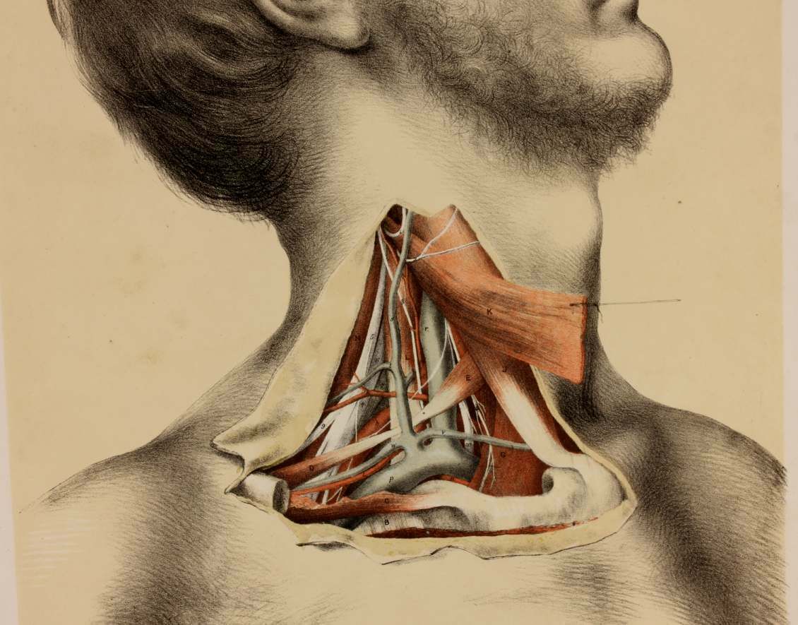 Original G Ellis Anatomy Lithograph Illustration Of Neck Dissection. 1864. photo for sale