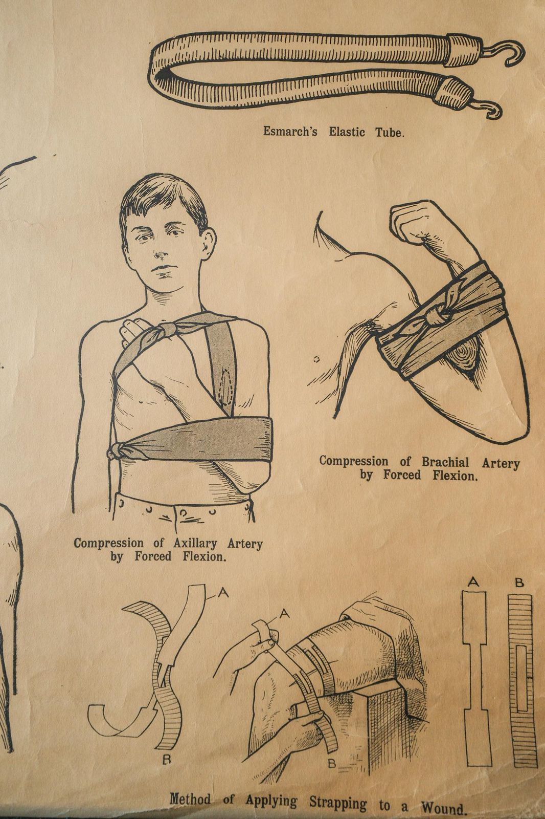 Original Anatomical Vintage British School Wall Chart Haemorrhage Wounds First Aid Anatomy Wright & Sons Tourniquet Compression photo vinterior