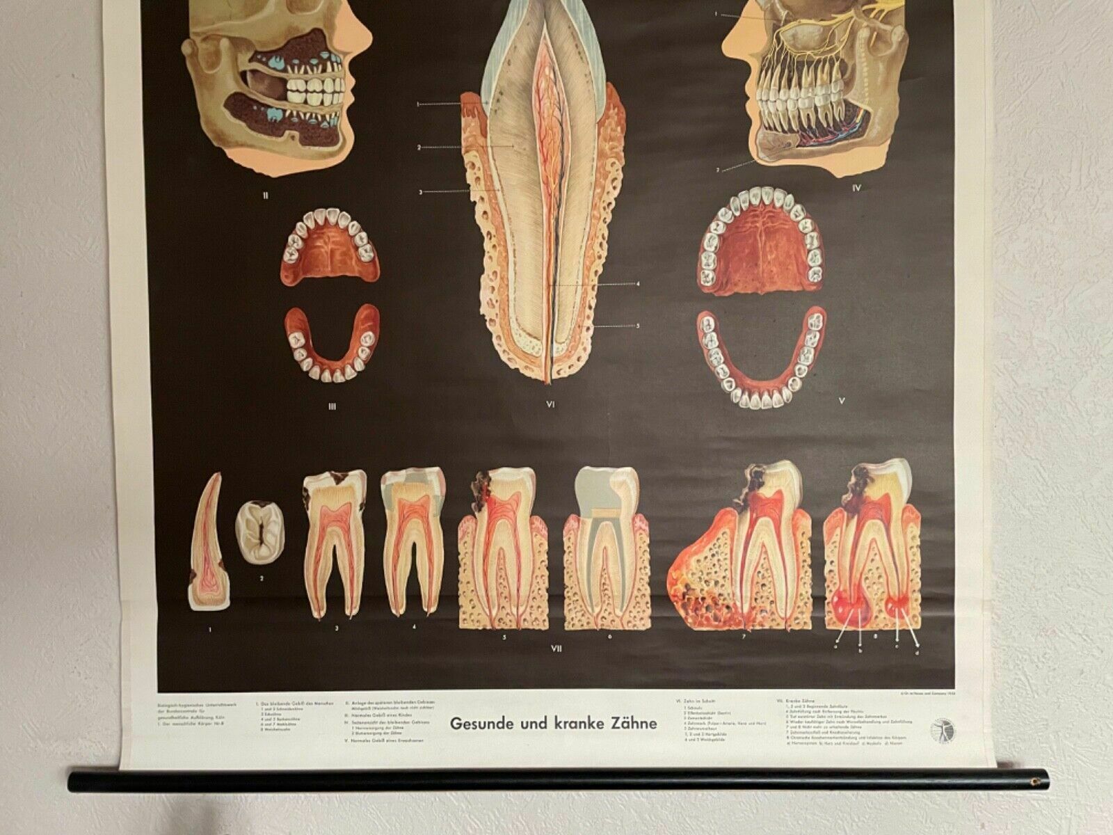 Vintage School Chart Teeth In Health & Disease Anatomy Educational Tooth Dental photo for sale