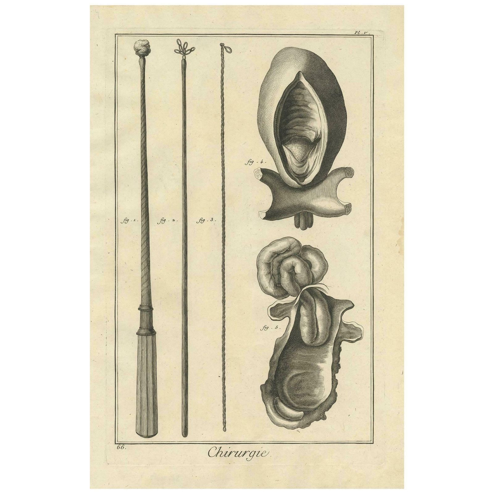 Antique Medical Print 'Pl. V' By D. Diderot, Circa 1760