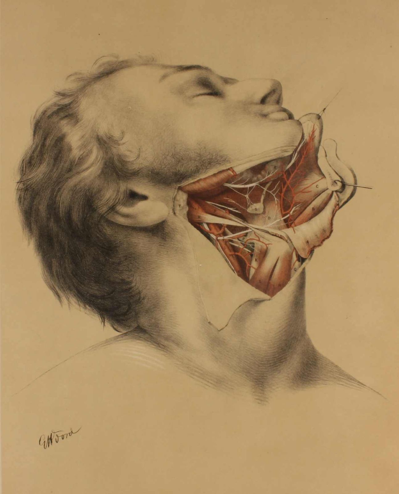 Illustration Of Dissection Of Throat. Anatomy Lithograph. G Ellis 1864.