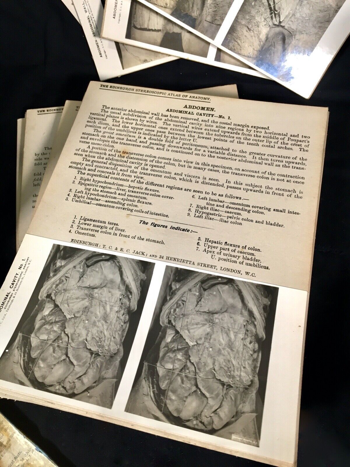 photo for sale Antique Pair Of Boxed Edinburgh Stereoscopic Atlas Of Anatomy Cards Views C.1905