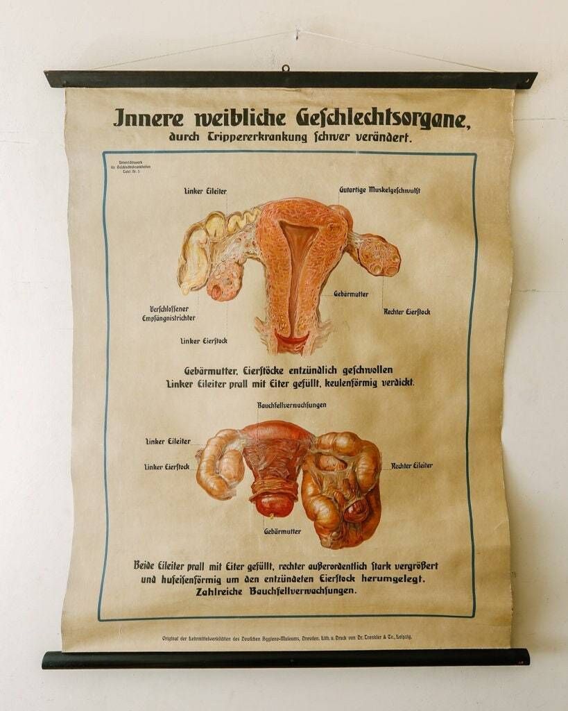 Original Anatomical Vintage German School Wall Chart Gonorrhea In Women Anatomy Medicine Venereal Disease Illness Science Graphic Rare