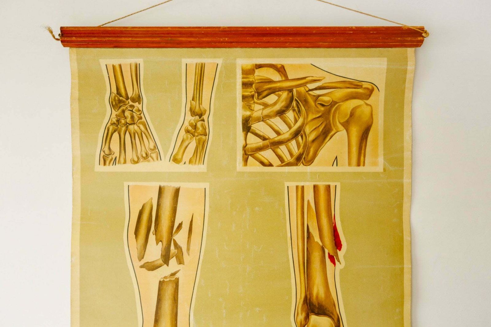 Original Anatomical Vintage British Educational School Wall Chart Bone Fractures Breaks Medicine St John's Ambulance Teck photo for sale