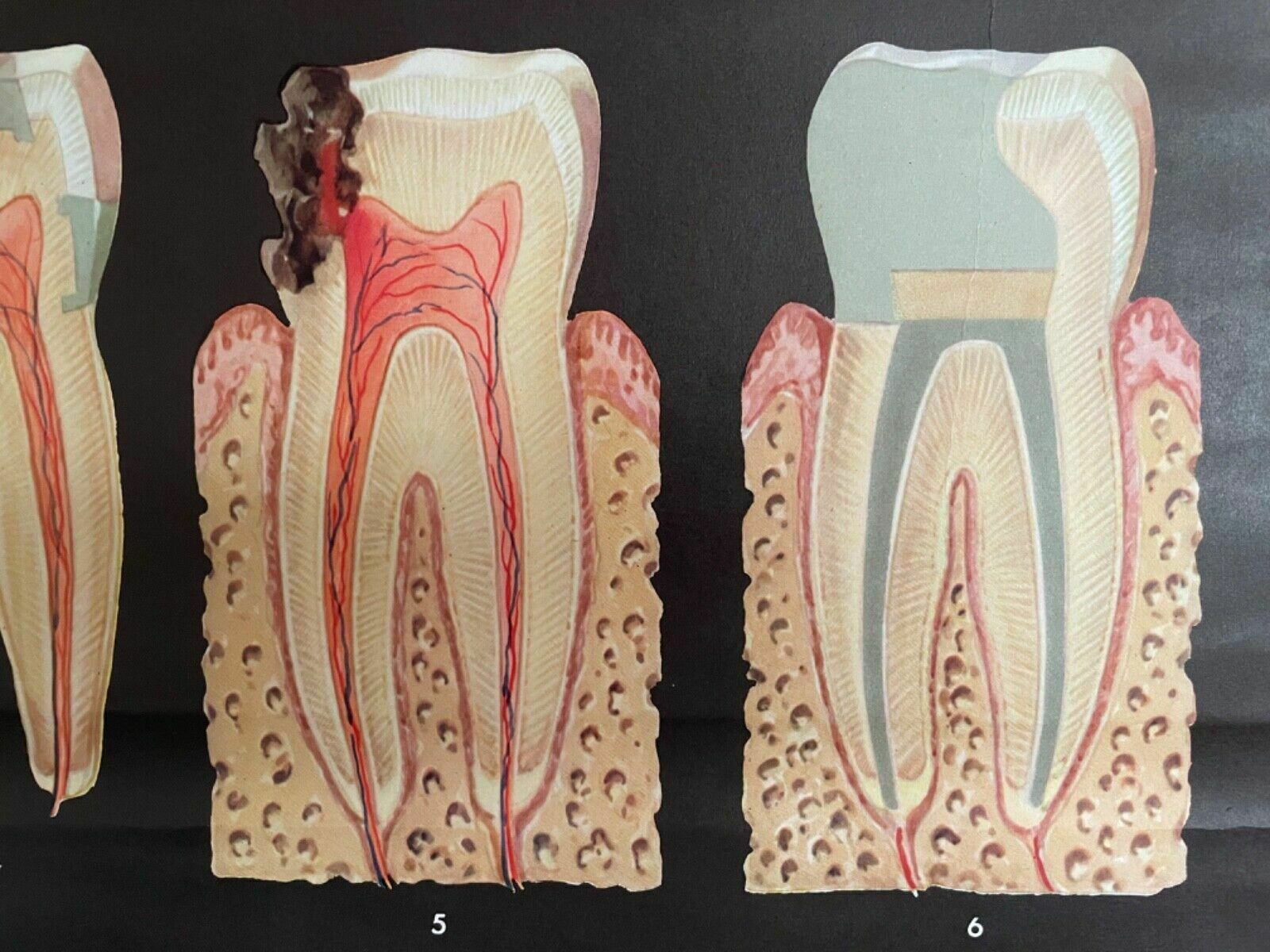 photo buy Vintage School Chart Teeth In Health & Disease Anatomy Educational Tooth Dental