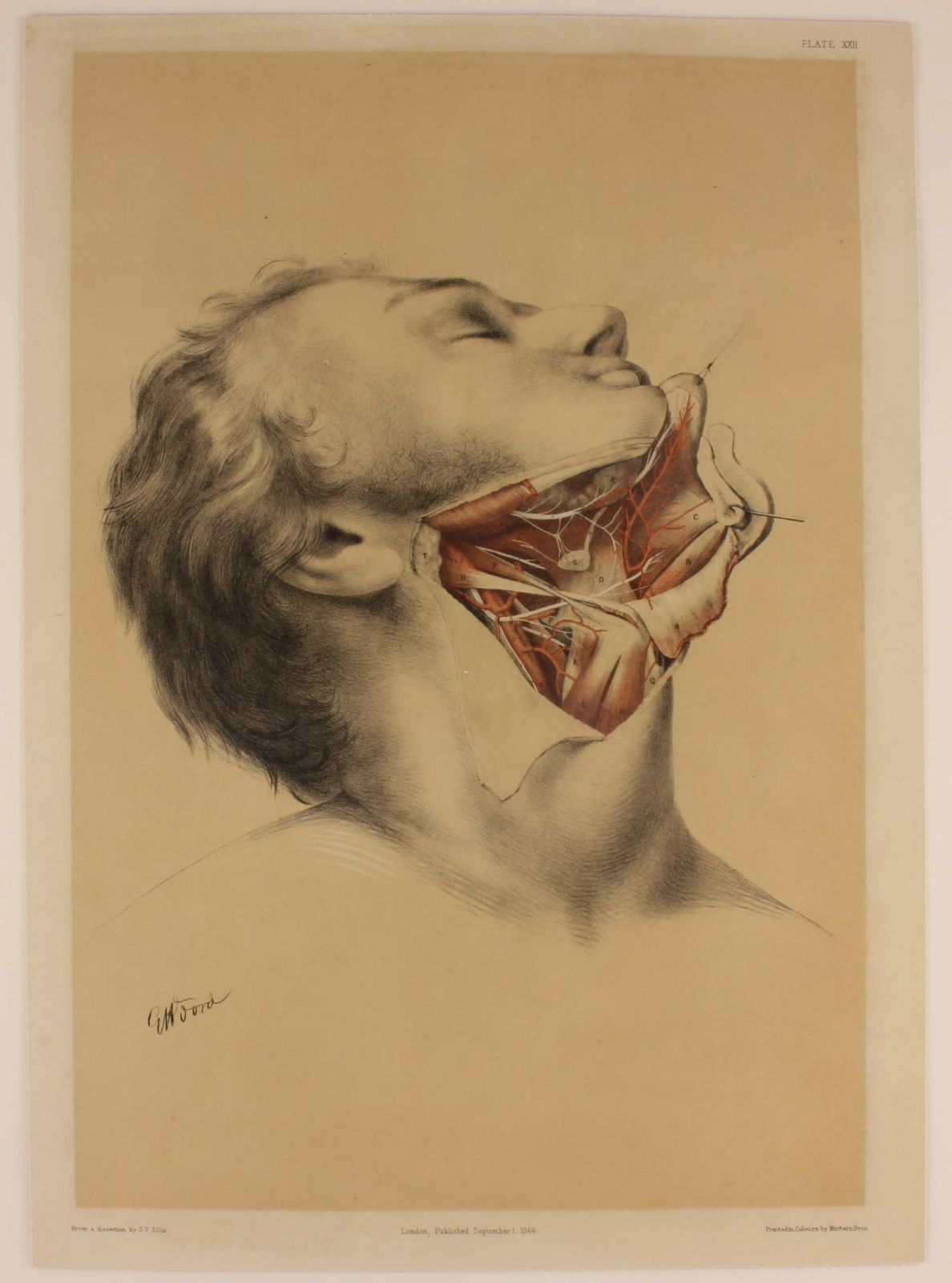 Illustration Of Dissection Of Throat. Anatomy Lithograph. G Ellis 1864. photo furniture