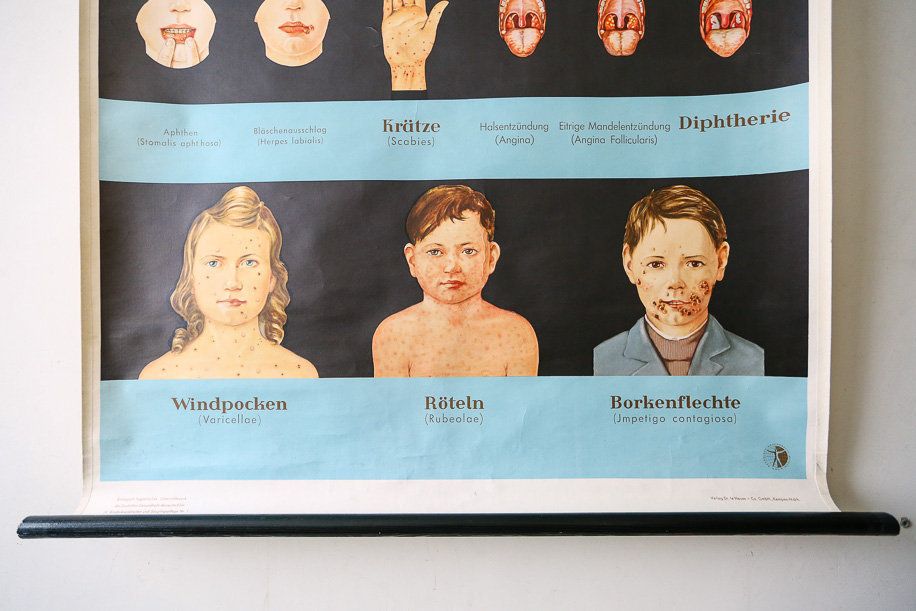 Original Anatomical Vintage German School Wall Chart Childhood Diseases Measles Chicken Pox Anatomy Medicine Science Beautiful Rare photo for sale