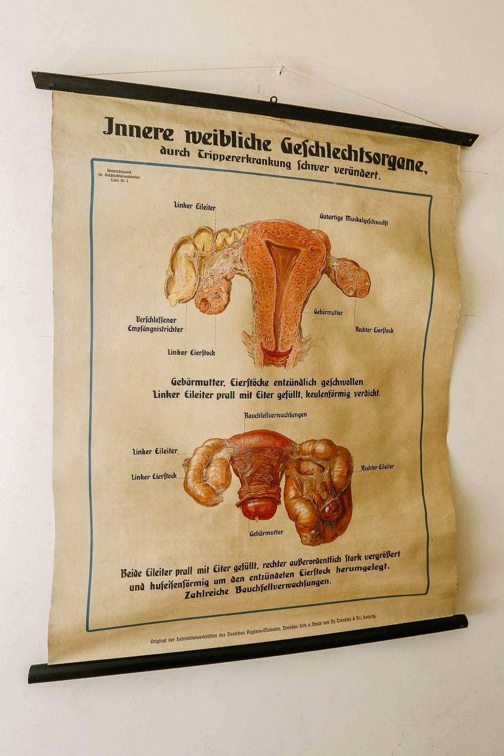 Original Anatomical Vintage German School Wall Chart Gonorrhea In Women Anatomy Medicine Venereal Disease Illness Science Graphic Rare photo furniture