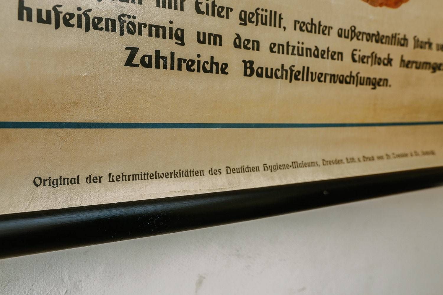 Original Anatomical Vintage German School Wall Chart Gonorrhea In Women Anatomy Medicine Venereal Disease Illness Science Graphic Rare photo 140.0
